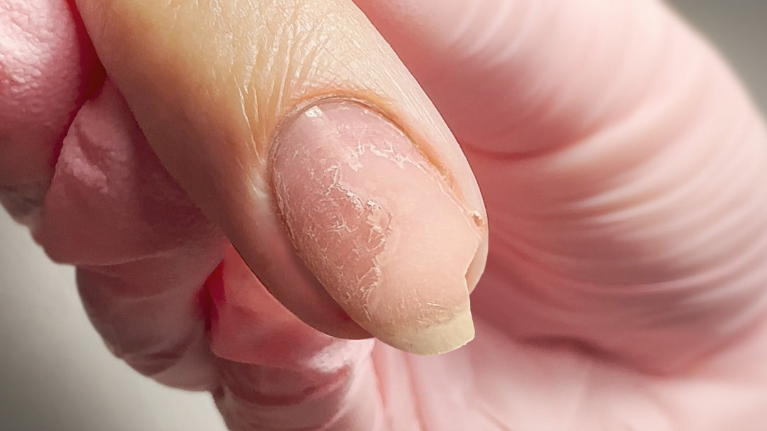 Unha quebrada: é mesmo necessário sacrificar o comprimento de todas as outras?